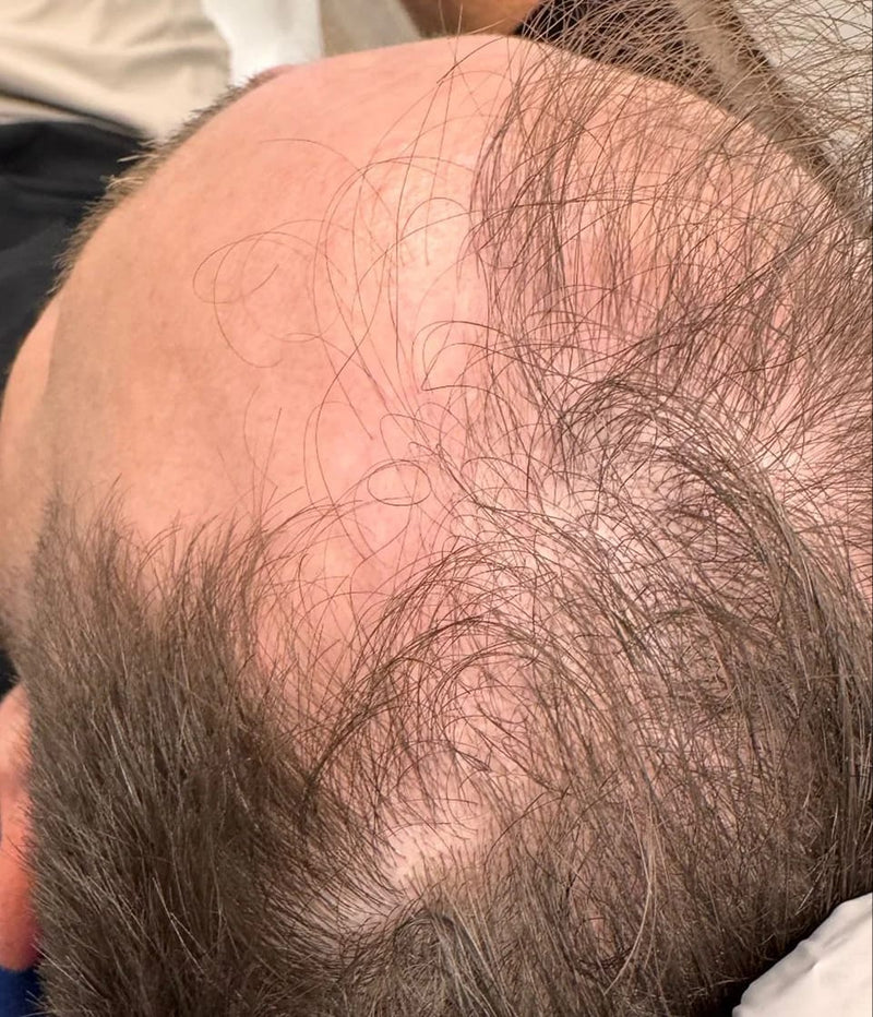 StimuField PEMF cap results after 2.5 months – male age 34, new hairs emerging in thinning areas