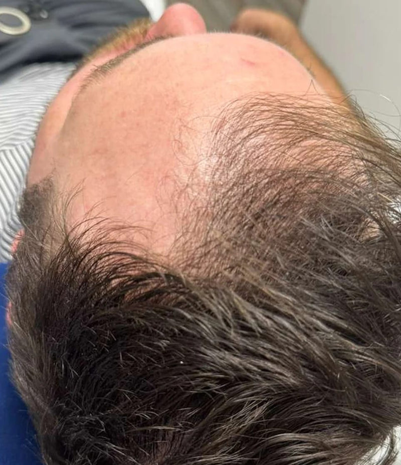 StimuField PEMF cap results after 5 months – male age 34, thicker and fuller hair, thinning areas filling in