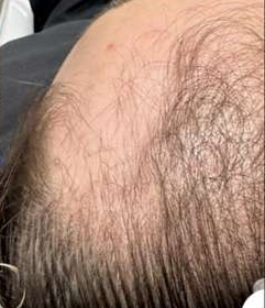 StimuField PEMF cap before photo – male user age 34, hair thinning at baseline before sessions