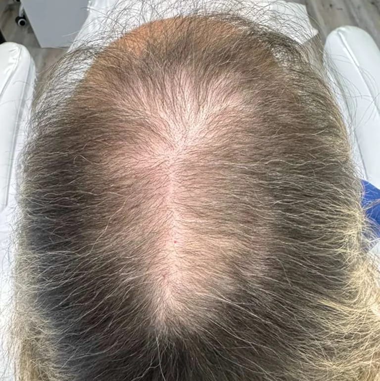 StimuField PEMF cap results after 2 months – female age 60, early hair regrowth and baby hairs visible