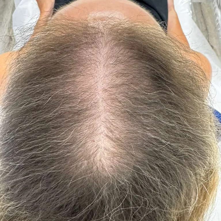 StimuField PEMF cap results after 4 months – female age 60, increased hair density and coverage