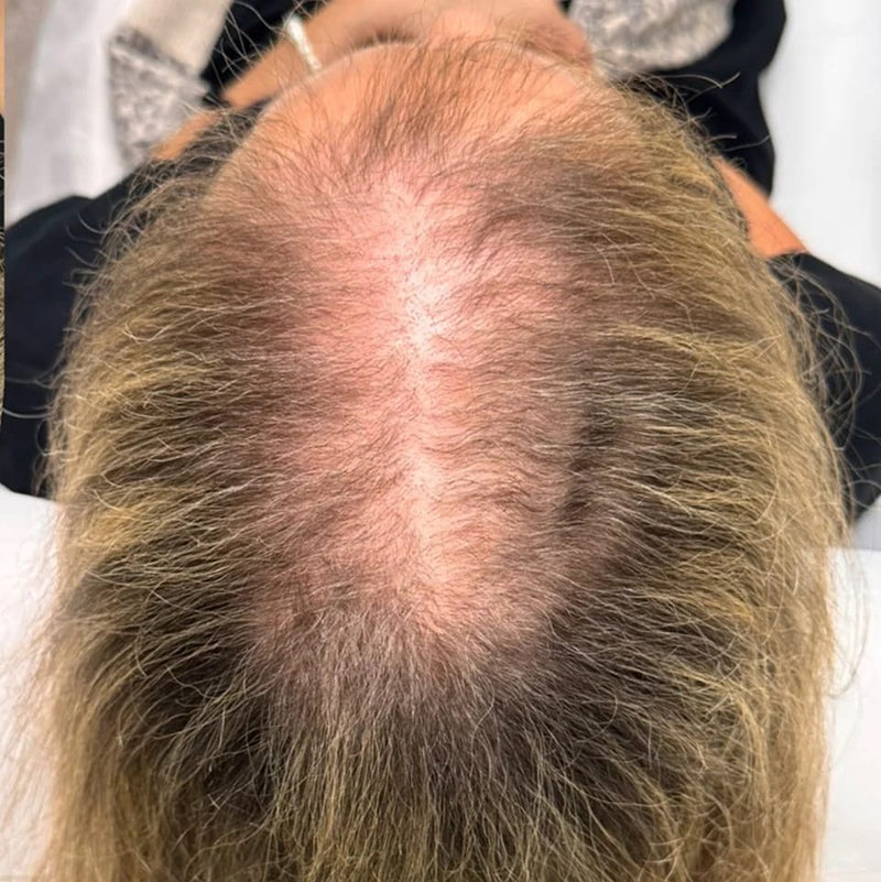 StimuField PEMF cap before photo – female user age 60, hair thinning on scalp baseline