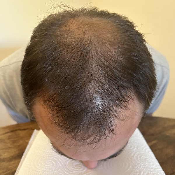 StimuField PEMF cap results after 3 months – male age 36, new hair growth visible especially at hairline