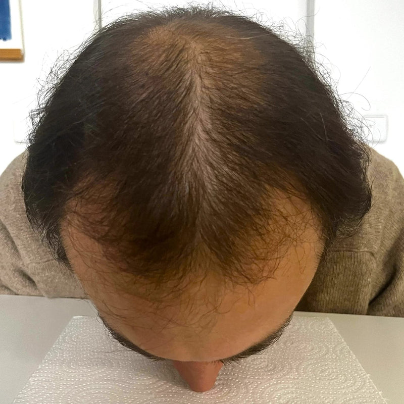 StimuField PEMF cap results after 7 months – male age 36, fuller hair volume and improved coverage