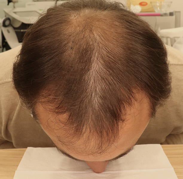 StimuField PEMF cap before photo – male user age 36, hair thinning at hairline and crown baseline