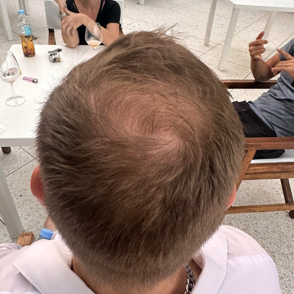StimuField PEMF cap before photo – male user age 36, thinning hair before PEMF sessions