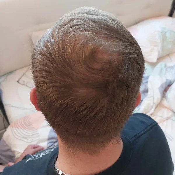 StimuField PEMF cap results after 6 months – male age 36, thicker hair and thinning areas filling in