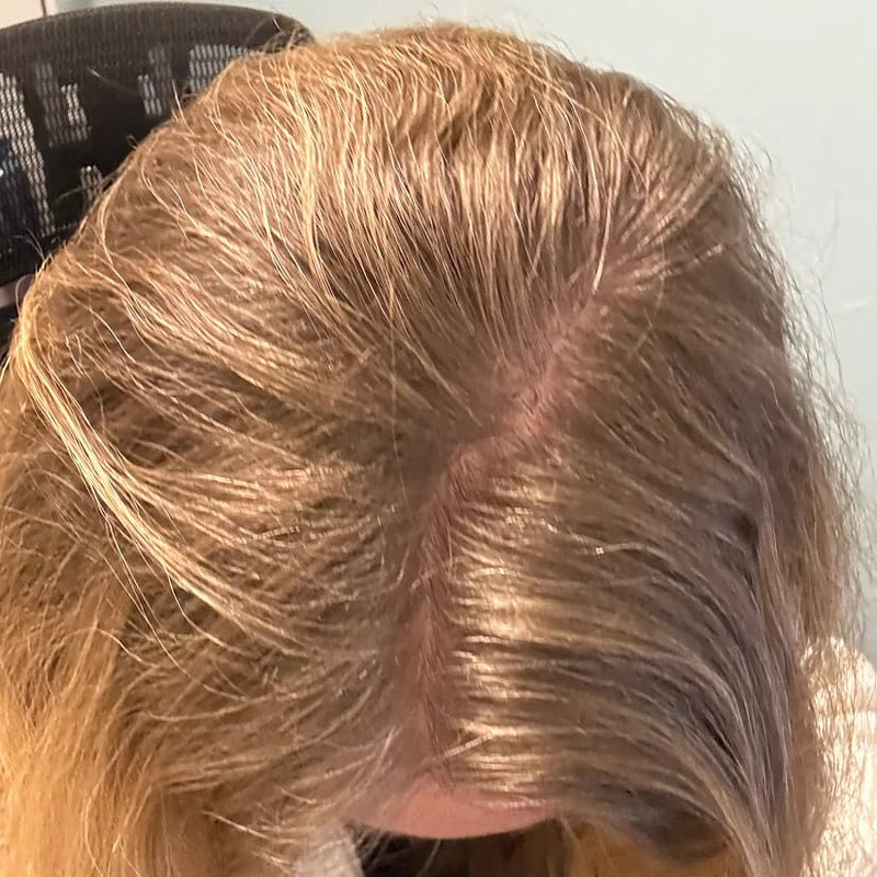 StimuField PEMF cap results after 5 months – female user, improved hair density and coverage
