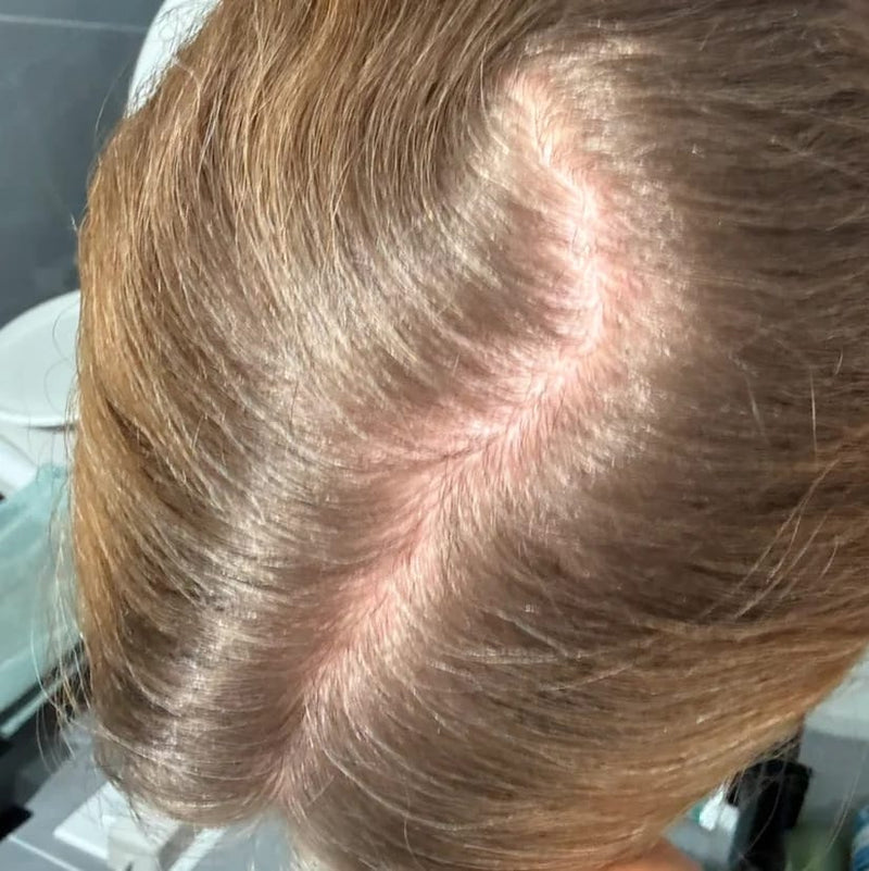 StimuField PEMF cap before photo – female user, hair thinning on scalp at baseline