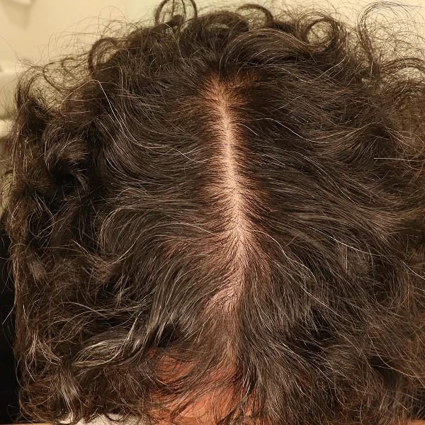 StimuField PEMF cap results after 4 months – male age 38, noticeable improvement in hair density