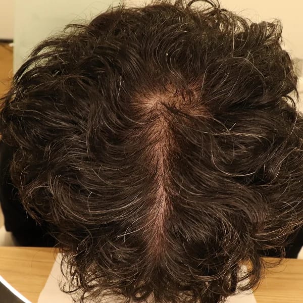 StimuField PEMF cap results after 7 months – male age 38, full density restored after years of thinning