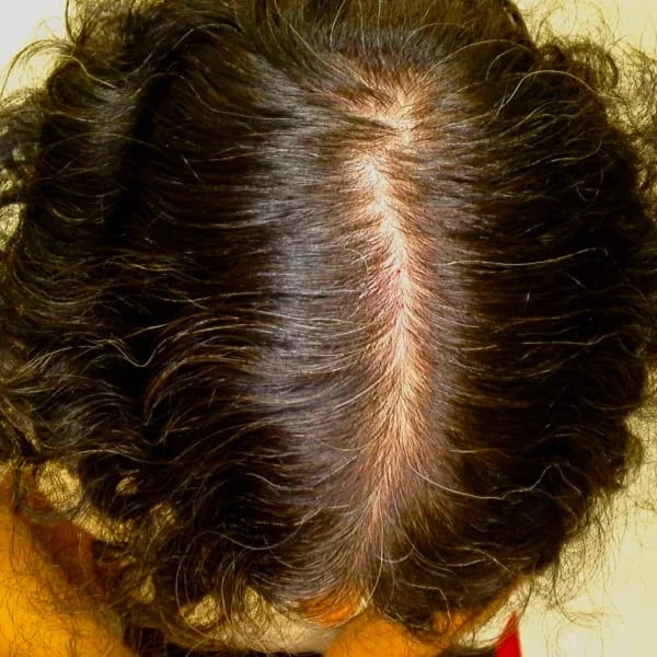 StimuField PEMF cap before photo – male user age 38, decade-long hair thinning at baseline